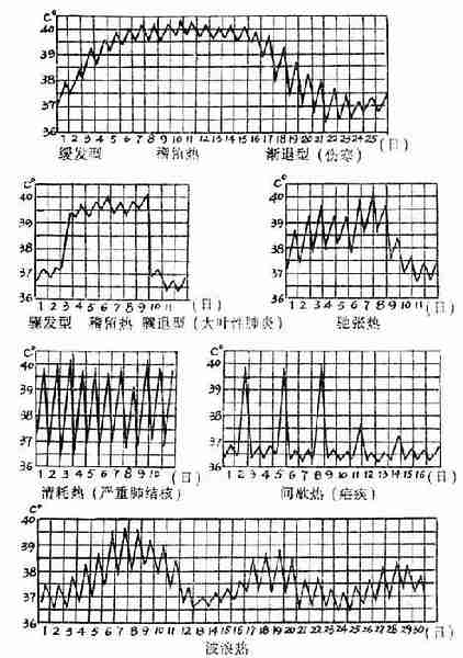 常见的发热热型