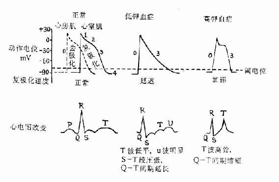 血浆钾浓度对心肌细胞膜电位及心电图的影响