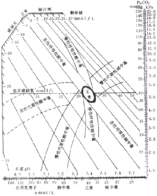 各种类型酸碱平衡紊乱时血浆pH、Pco2、HCO3- 变化示意图