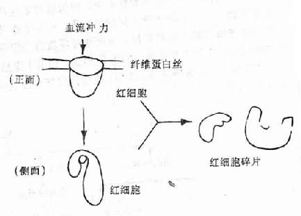 红细胞碎片的形成机制