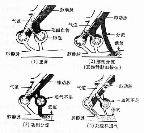 肺泡通气与血流比例失调模式图