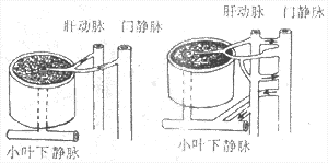 肝硬变时肝内血液循环变化示意图