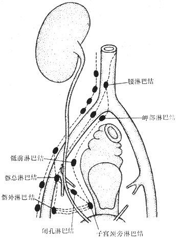 子宫颈癌淋巴道转移示意图