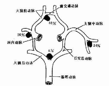 基底动脉环各处先天性球性动脉瘤的发生率