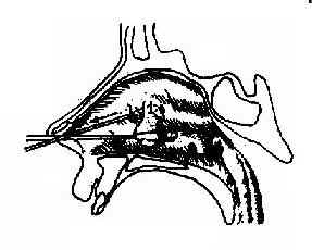 鼻息肉摘除术