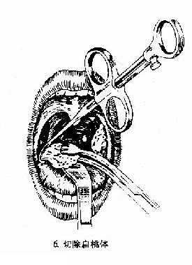 扁桃体切除术（剥离法）