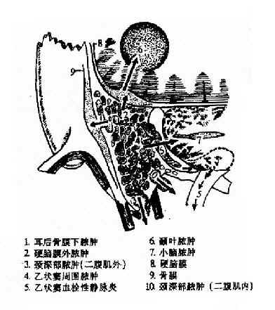 耳源性并发症扩散示意图