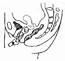 子宫脱垂分度