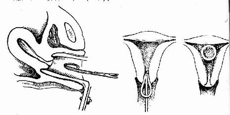 用放环钳送入宫腔