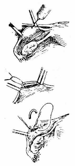 输卵管管心抽出结扎法