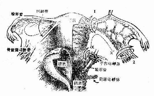 切除子宫时主要血管的缝扎部位