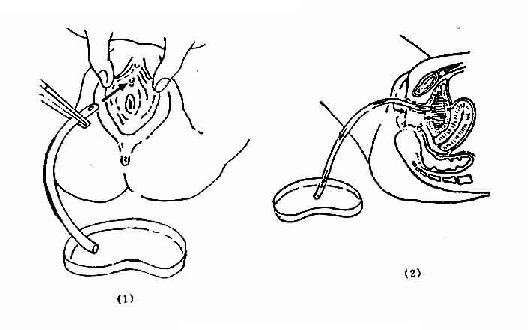 女性导尿术