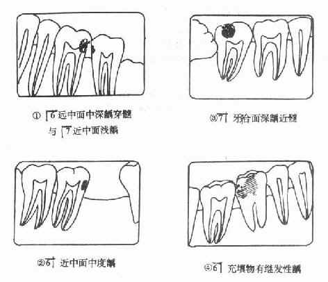 各类龋示意图