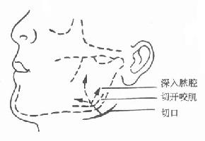 咬肌下蜂窝织炎切开引流