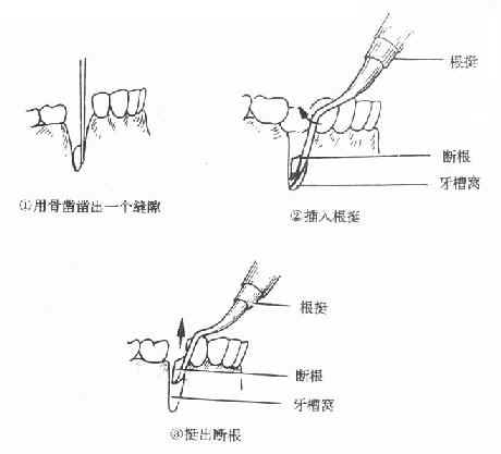 断根拔除法示意图