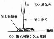 乳头状腺瘤