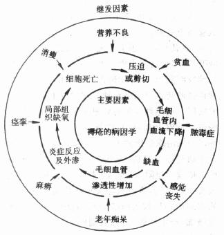 褥疮的病因学