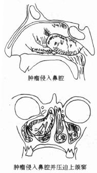 鼻咽纤维瘤