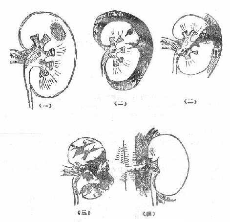 肾脏创伤的类型