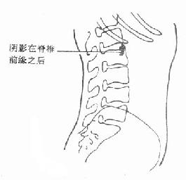 肾结石X线侧位平片