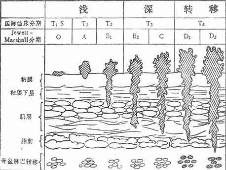 膀胱肿瘤临床分期