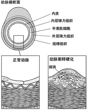 动脉粥样硬化