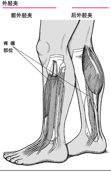 外胫夹