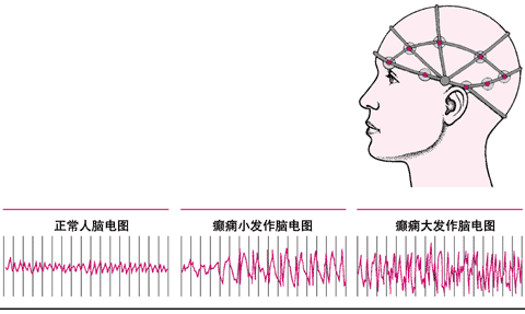 癫痫发作时的脑电活动