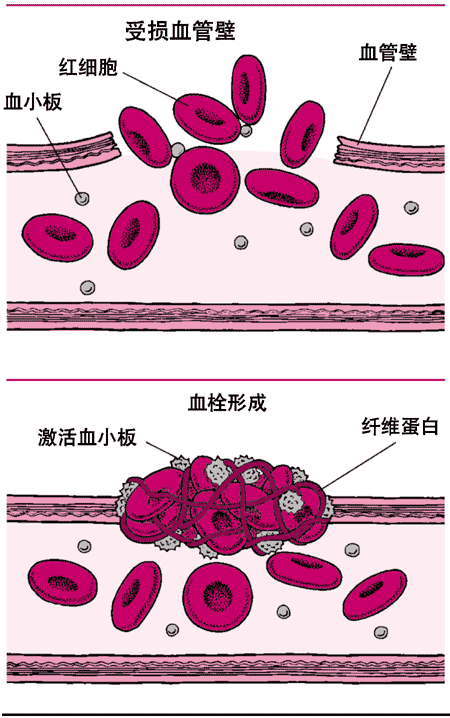 血凝块