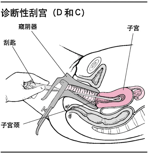 诊断性刮宫（D和C）