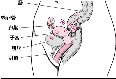 子宫内膜异位症：错位的组织