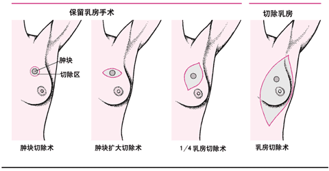 乳腺癌手术