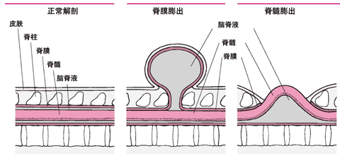 脊柱裂