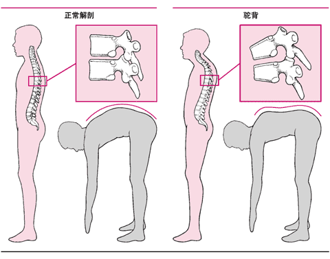 驼背