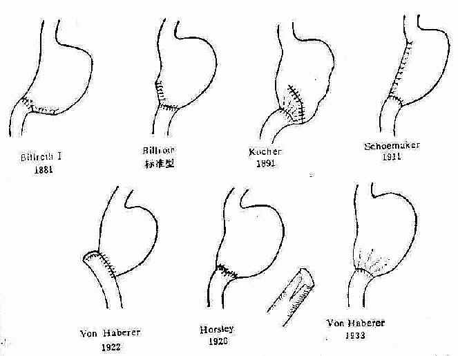 Billroth I 式胃大部切除术方法的变迁