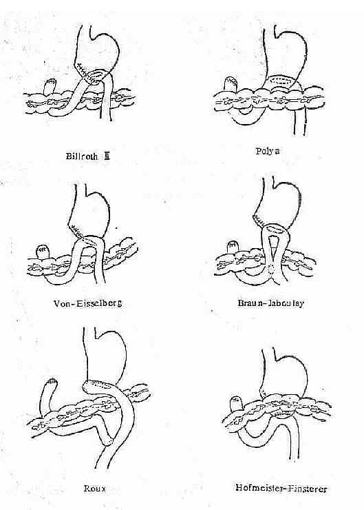 Billroth Ⅱ式胃空肠吻合的不同方法