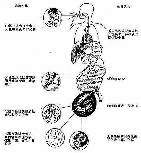 肠梗阻局部和全身变化示意图