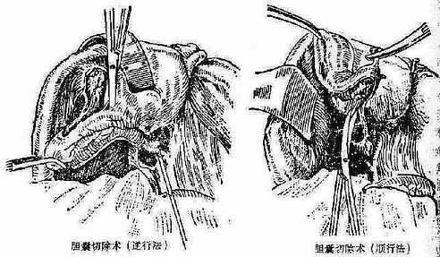 胆囊切除术