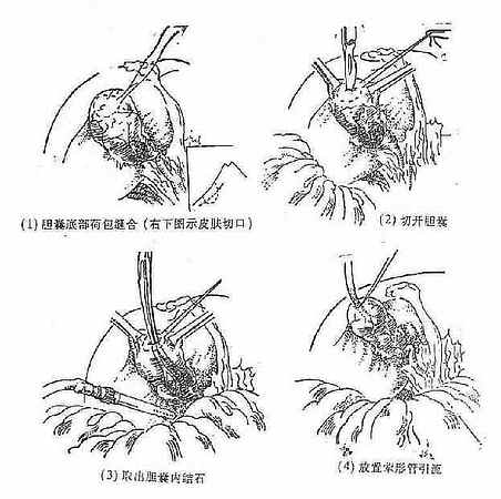 胆囊造瘘术