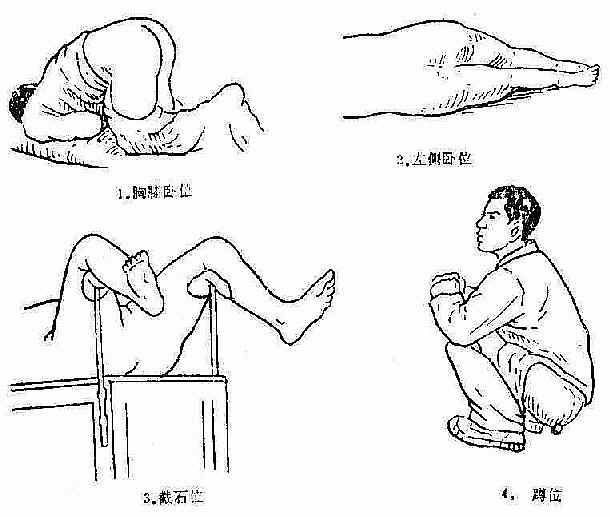 肛门直肠检查体位