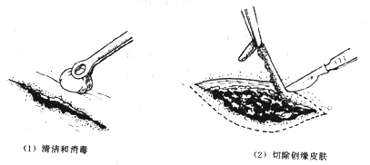 清创术基本步骤