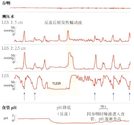 测压术中所见TLESR