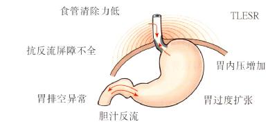 GERD主要发病机理小结