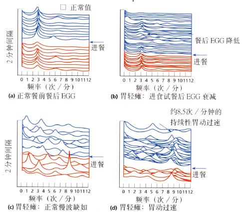 正常情况和胃轻瘫EGG的区别