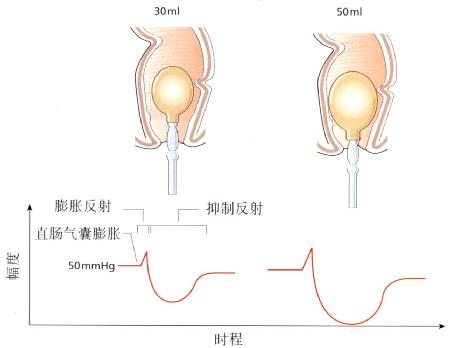 直肠肛门抑制反射