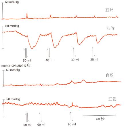 Hirschsprung病患者与正常人肛管压力对直肠扩张反应曲线