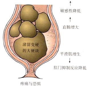 巨直肠病理生理学