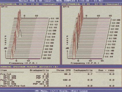 快速富里叶（Fourier）分析法进行EGG检查图例