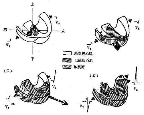 心室除极程序与各瞬间向量