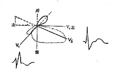 右束支传导阻滞的横面QRS向量环示意图